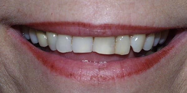 angelina-before