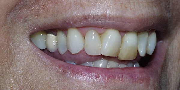 laurel-before